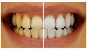 8 Astuces Naturelles Pour Éliminer les Dents Jaunes